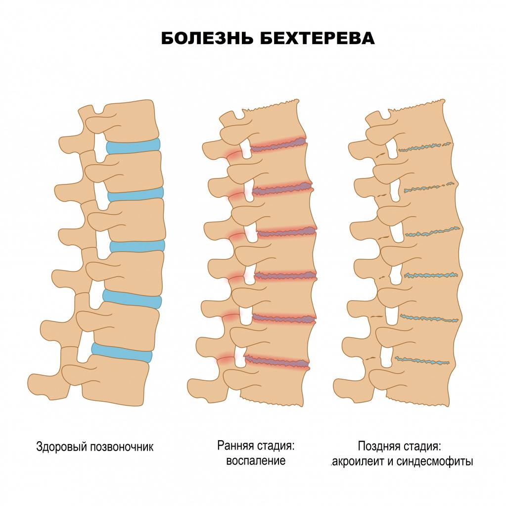 Матрас при болезни бехтерева