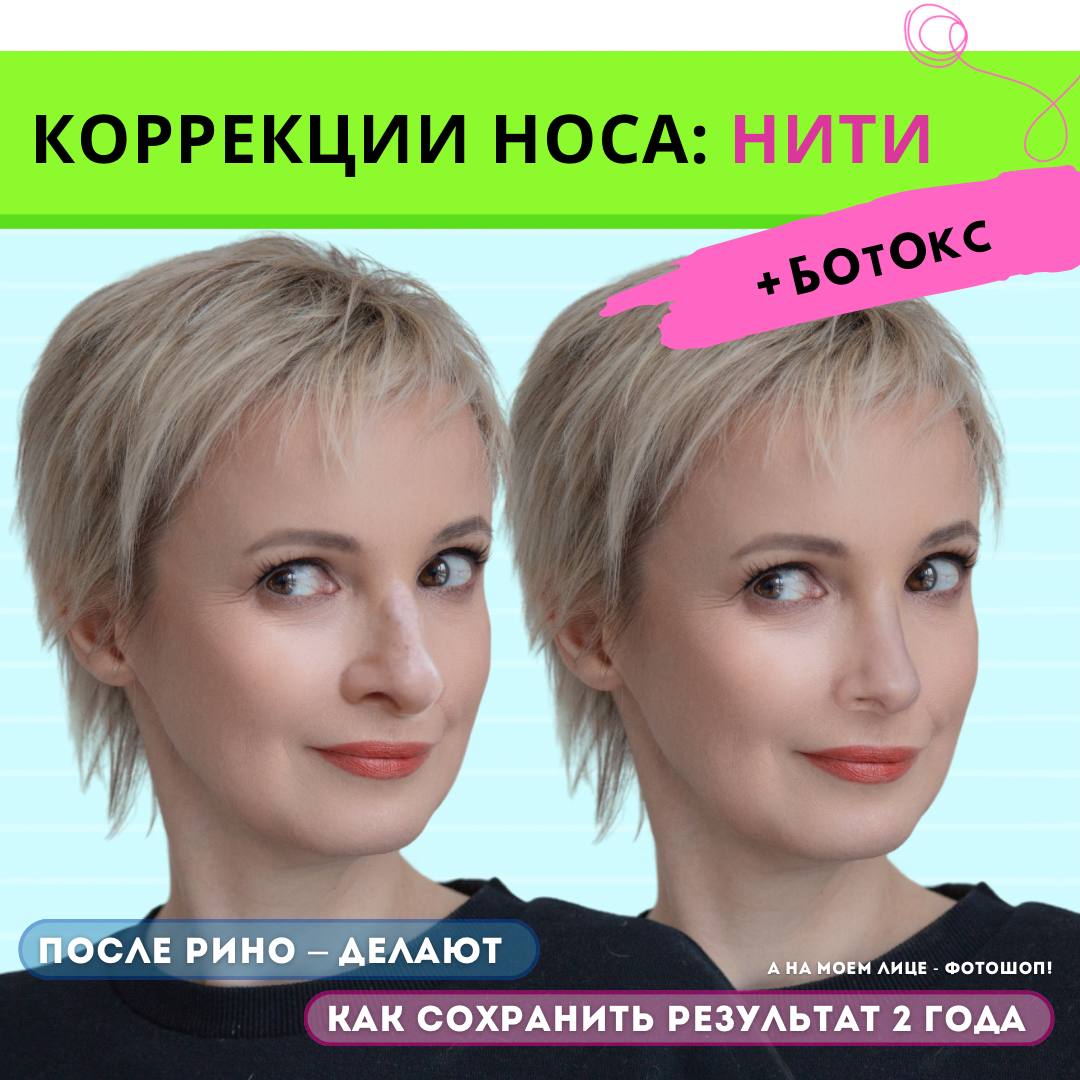 Коррекция Носа Нитями Фото